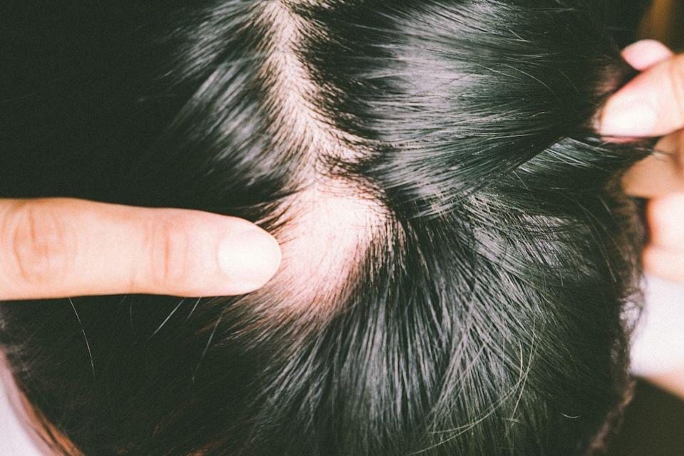10 Itchy Scalp Causes That Having Nothing to Do With Your Shampoo