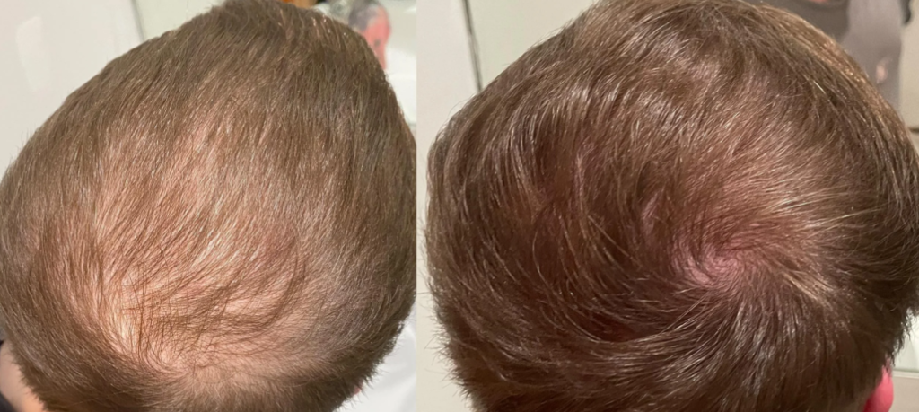 15 months on finasteride (photos)