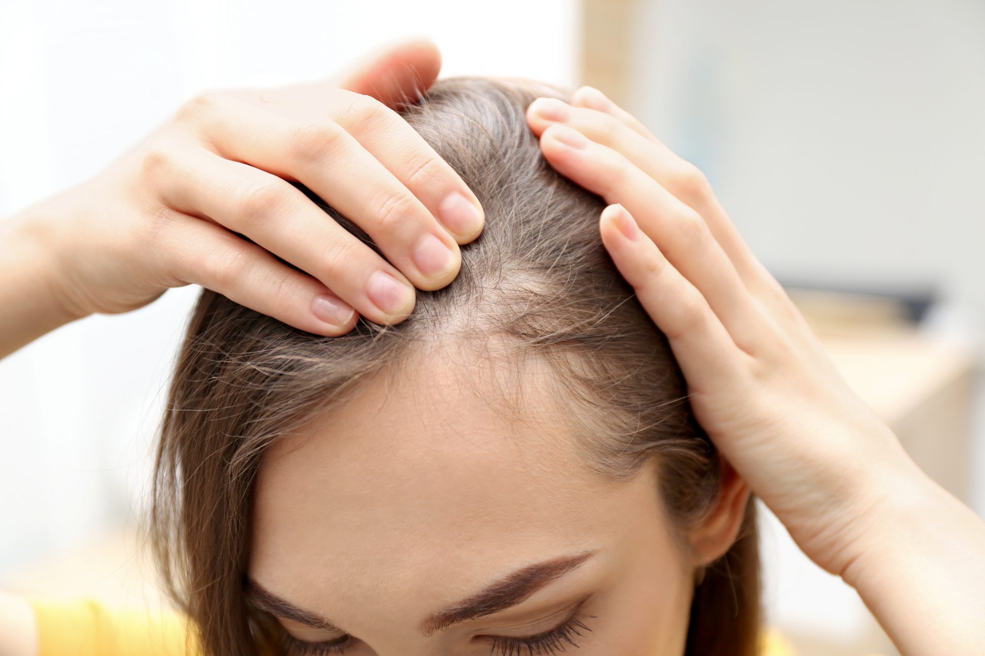 19 Causes of Hair Loss, How to Treat It