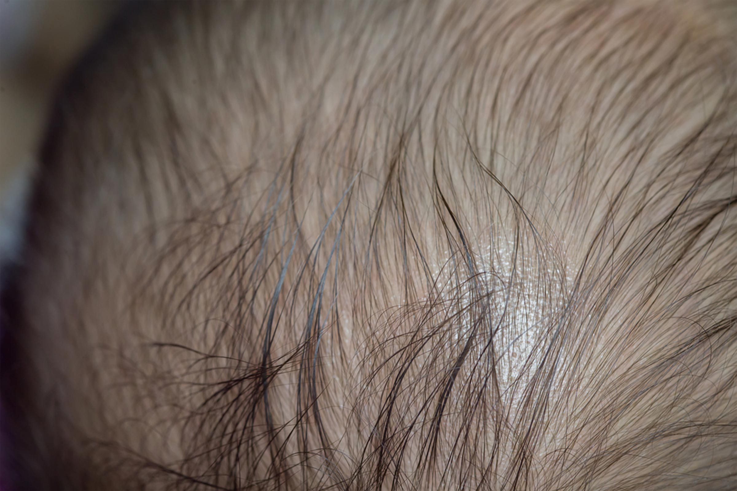 20 Reasons for Your Itchy Scalp (Besides Head Lice)