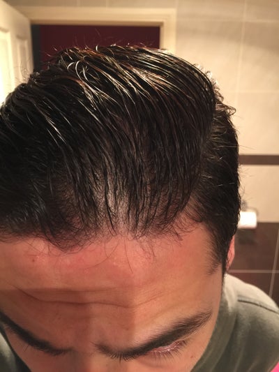 20 years old and I have noticed my hair thinning on my ...
