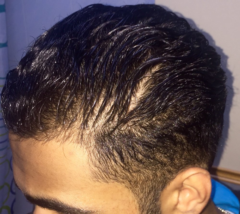 21 Years Old, Am I Diffuse Thinning?? Need Some Advice ...