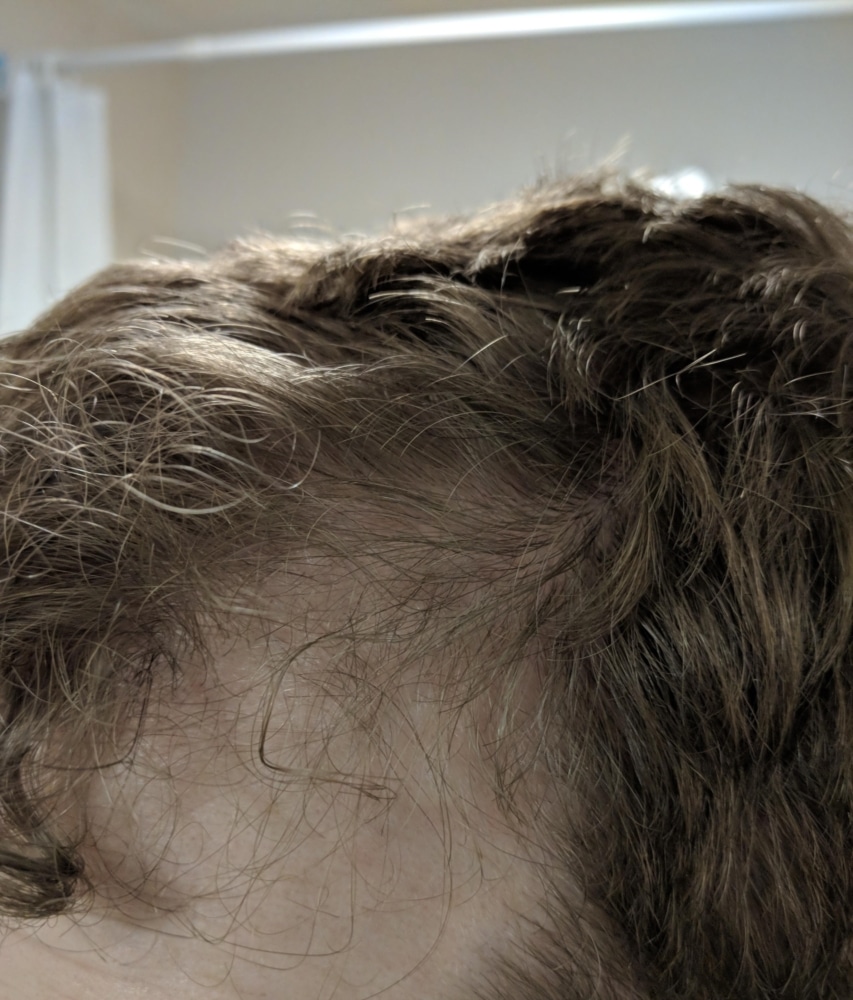 26 year old, unsure about my hair loss