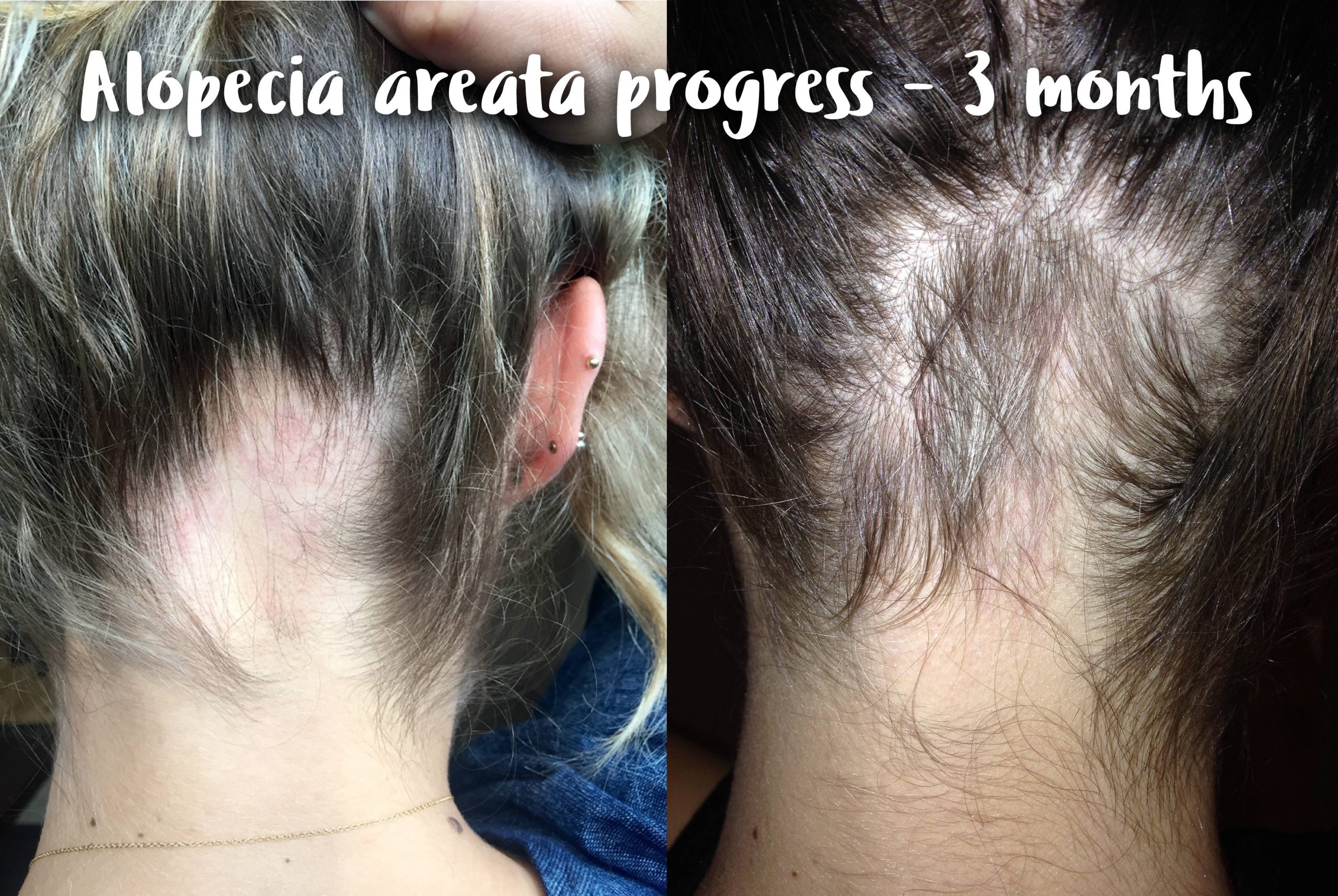 28/F Alopecia areata small victory. 3 month progression ...