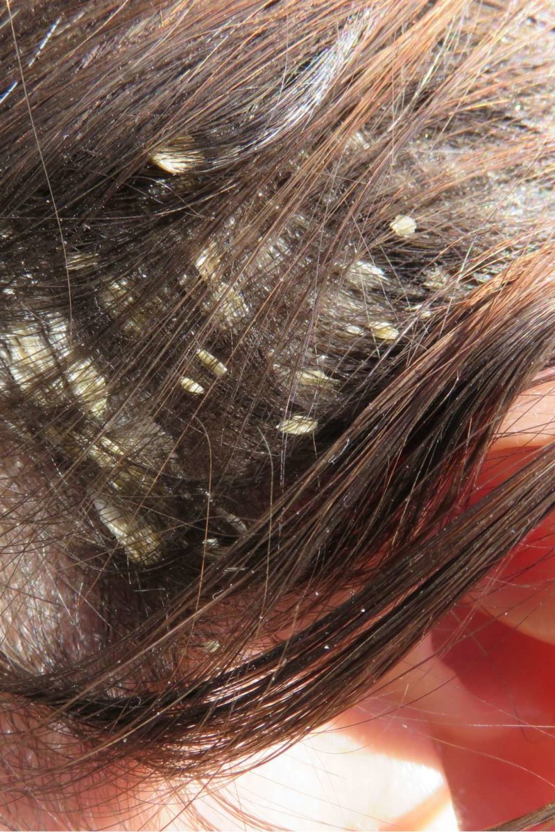 36 Top Photos Baby Dry Scalp Hair Loss : Dry Scalp And How It Relates ...