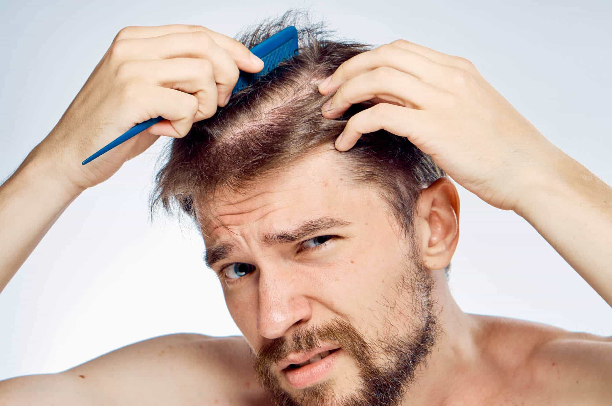 4 Common Causes of Hair Loss in Men