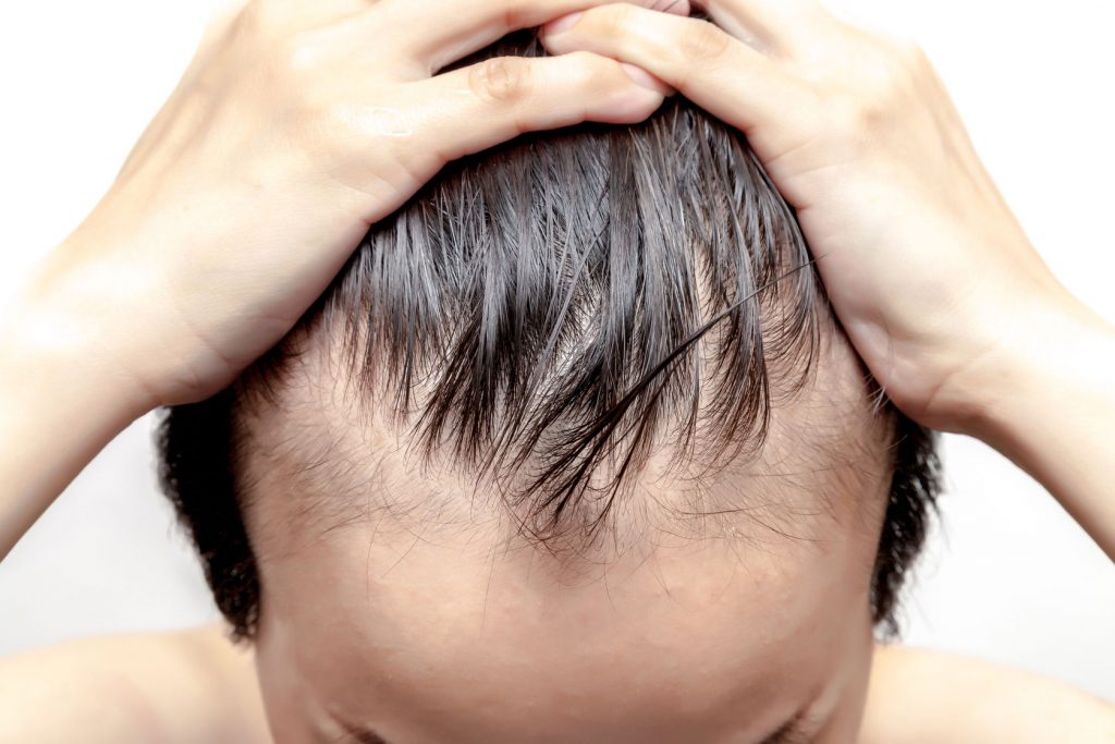 5 Causes of Hair Loss in Men at a Young Age