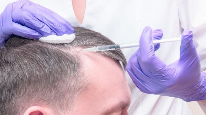 5 Most Effective Treatments for Hair Loss in 2020 ...