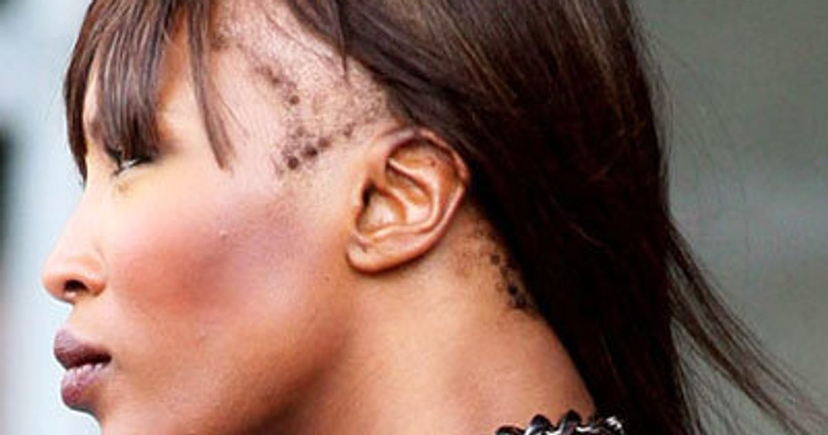 5 Reasons Why Your Hairline Might Be Receding