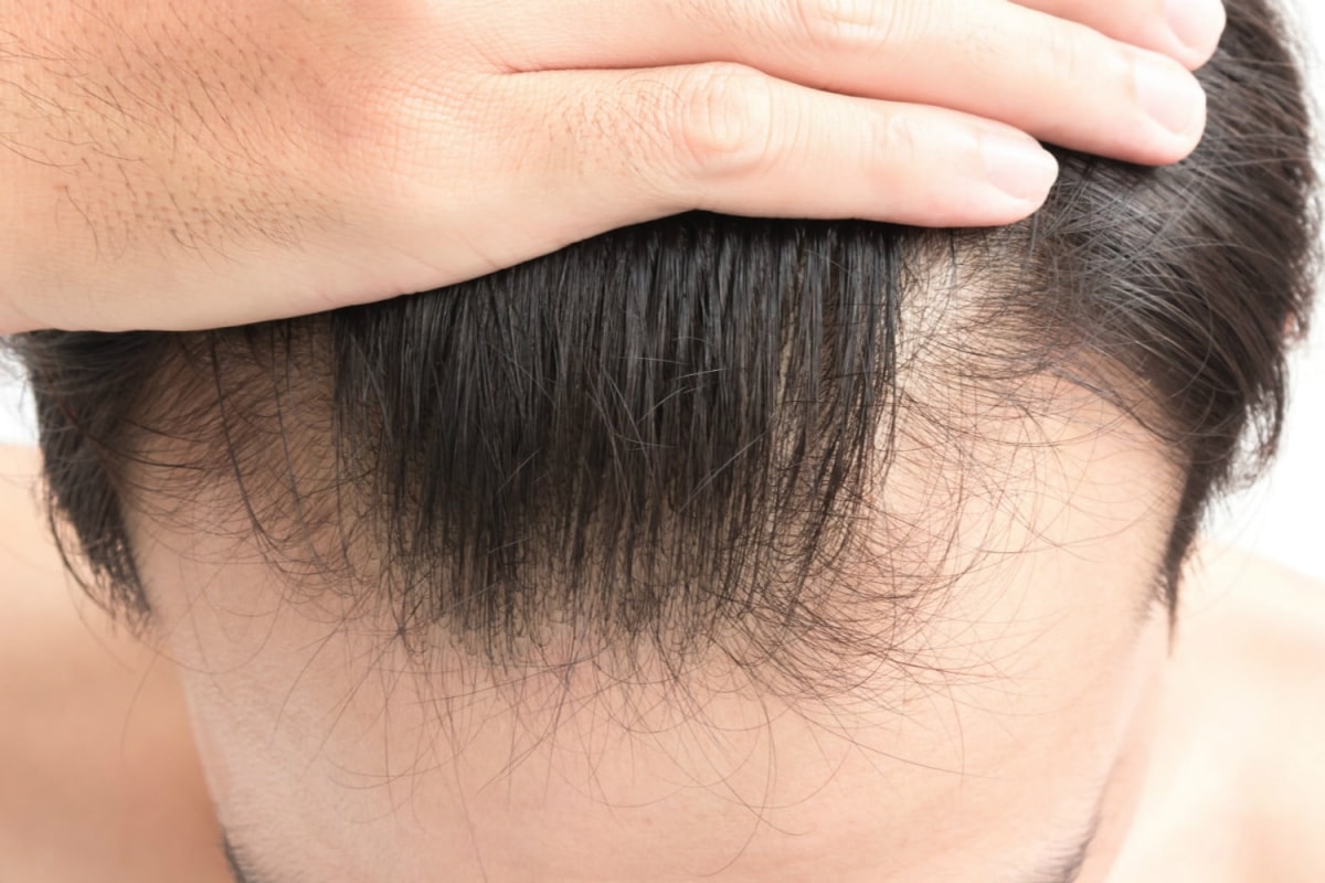 7 Simple Ways To Help Prevent Hair Loss In Men