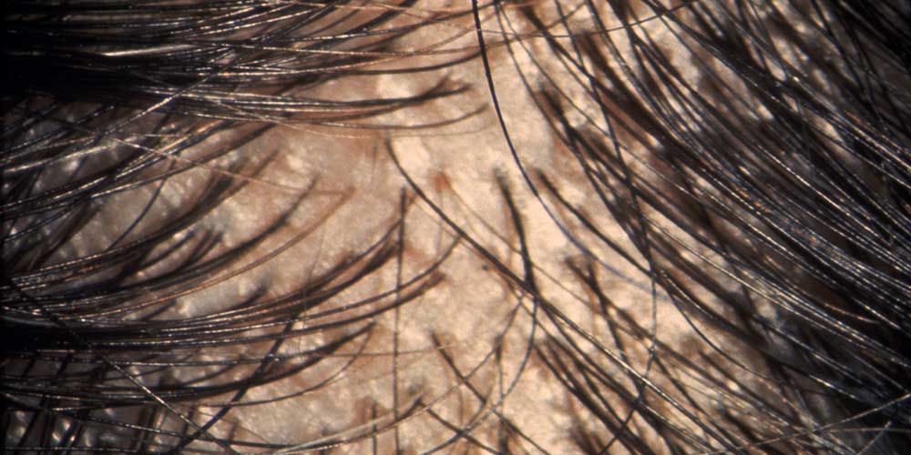 8 Ways To Tell If Your Hair Is Thinning Before It