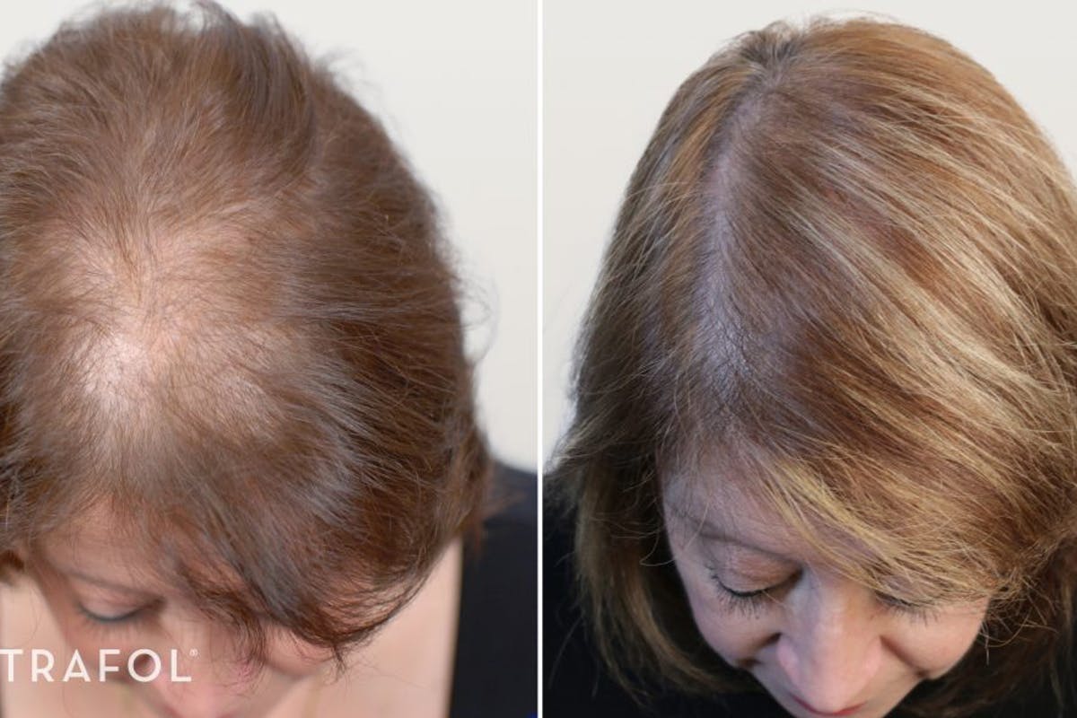 8 Women Who Took Control Of Hair Thinning With Nutrafol ...
