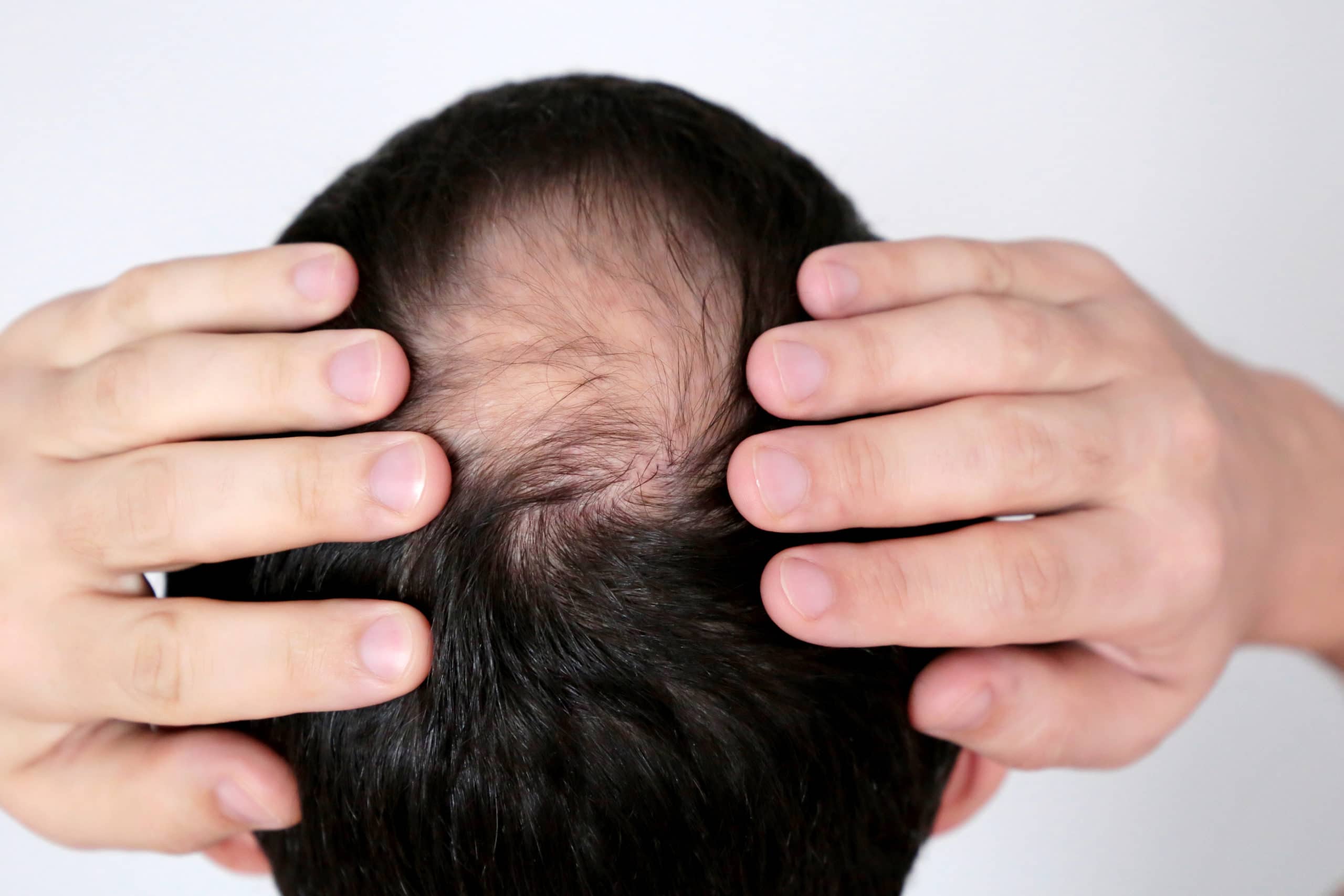 A Complete Guide to Kiierrâs Laser Cap for Hair Loss ...