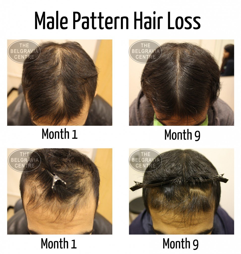 About finasteride for male pattern baldness
