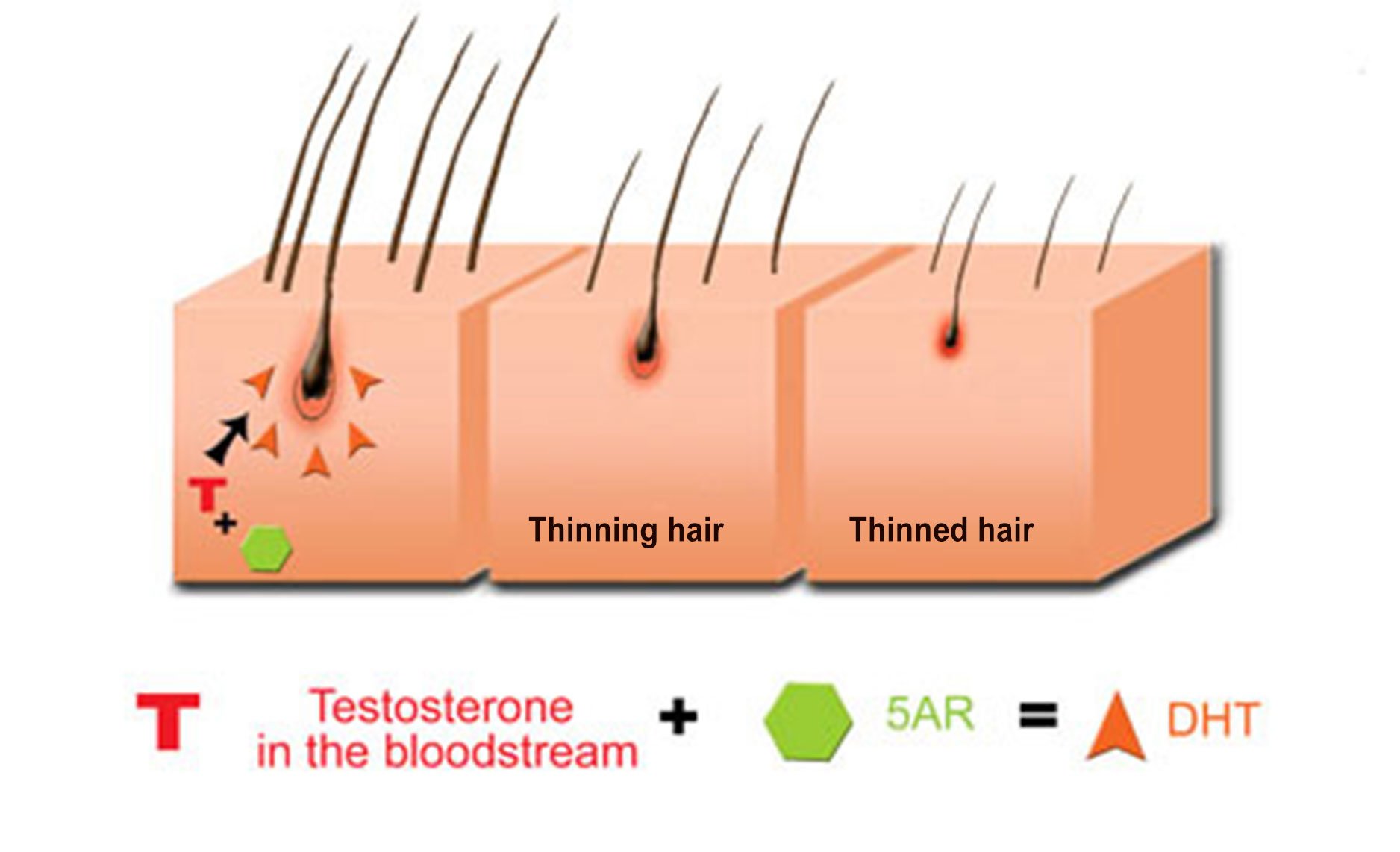 about hair loss dht how does it cause hereditary hair loss