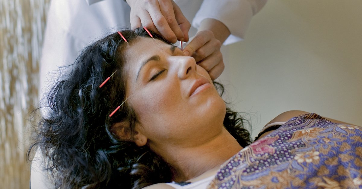 Acupuncture for Hair Loss: Is it Effective?