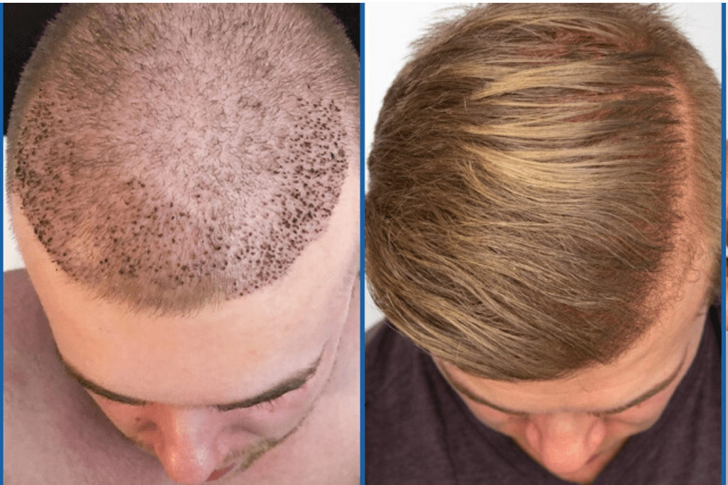 All You Need To Know About Hair Transplant Success Rate ...