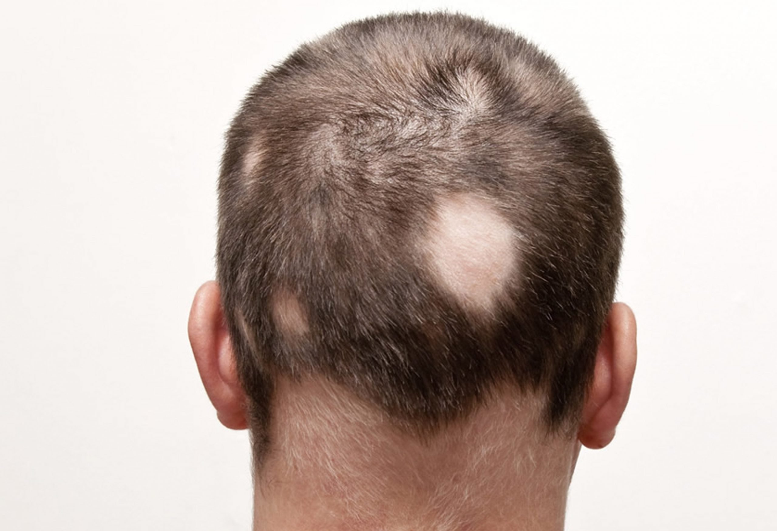 Alopecia and Hair Loss