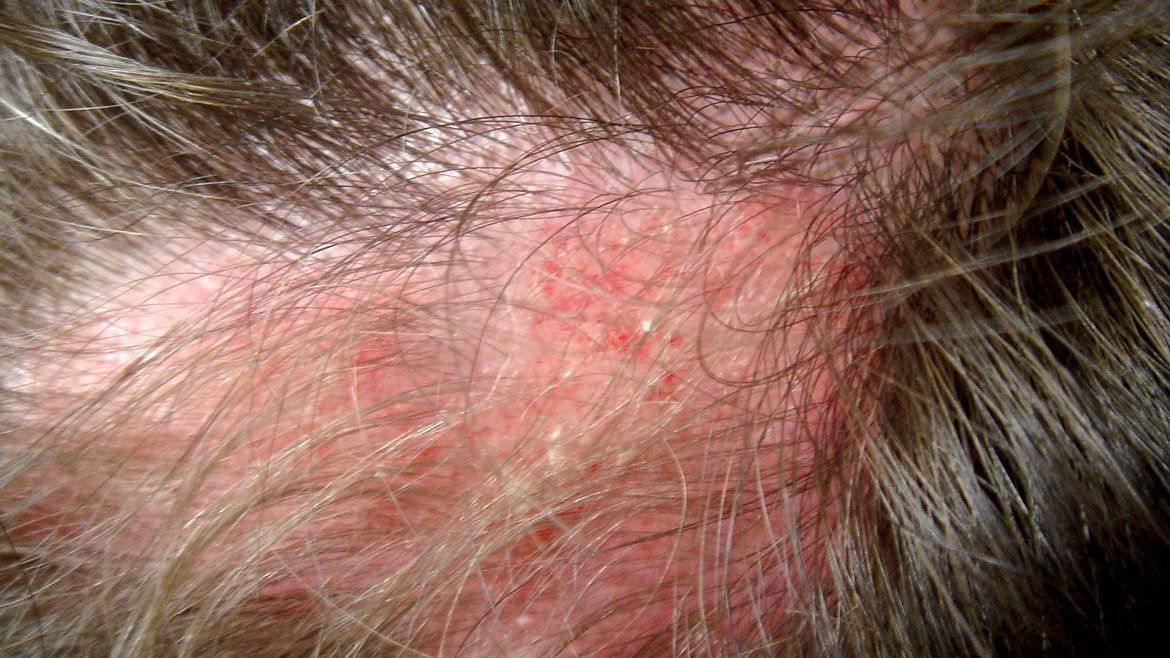 Alopecia and systemic Lupus erythematosus: correlations ...