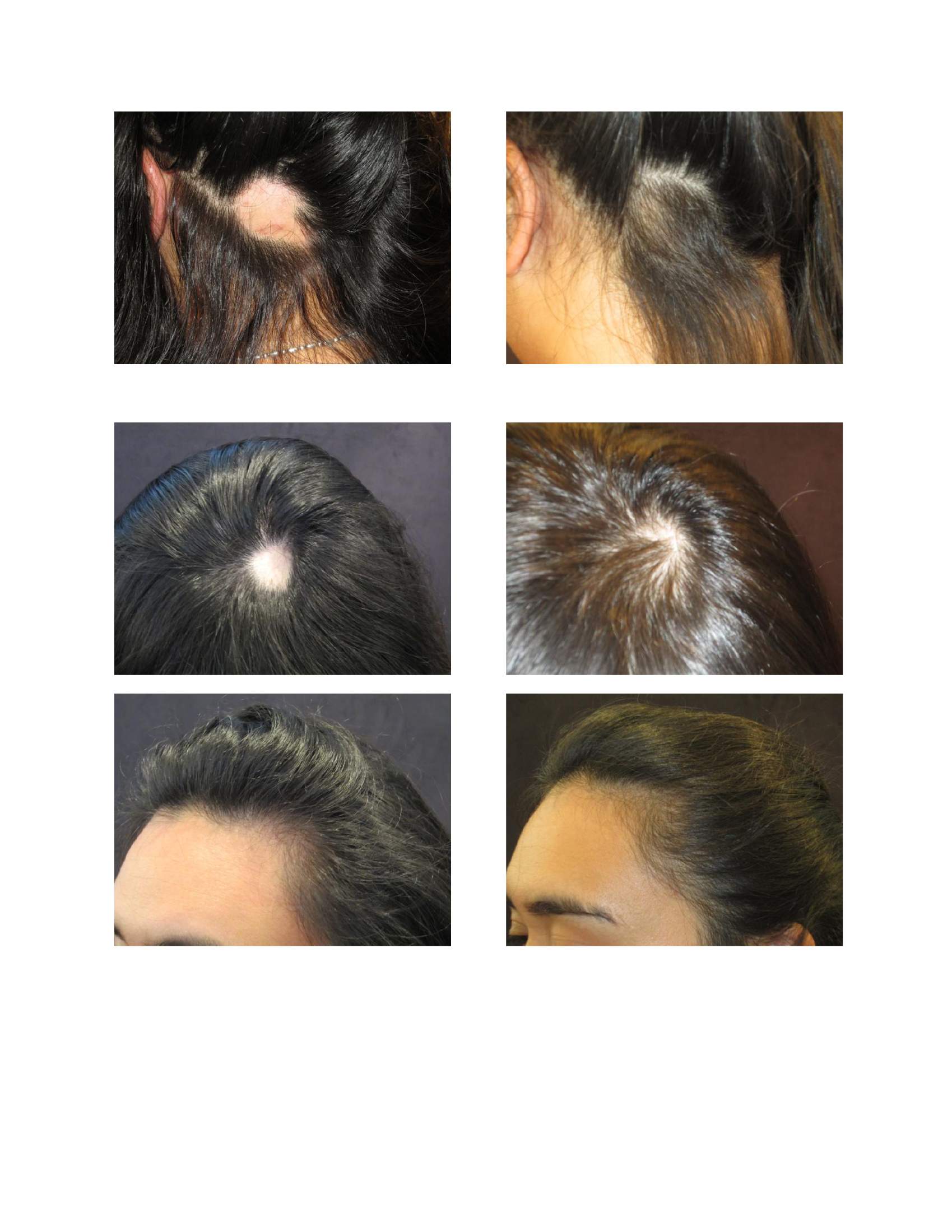 Alopecia Areata and Hair Loss Treatments with Trichologist