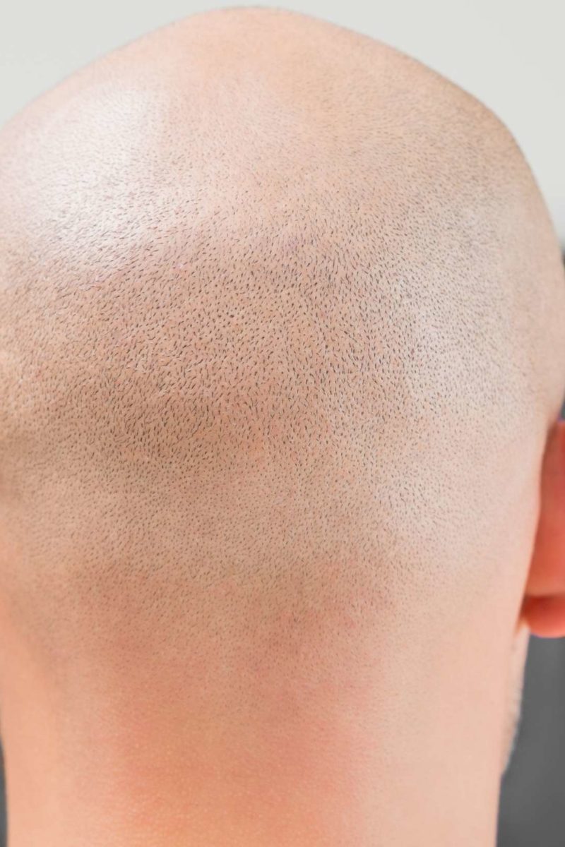 Alopecia totalis: Symptoms, treatments, and types