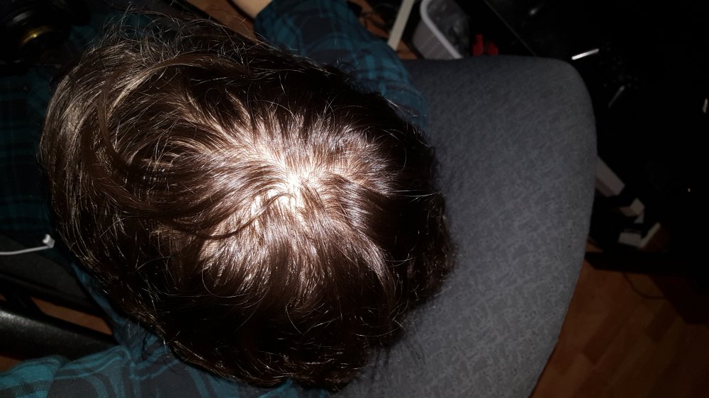 Am I Going Bald? I Am 15 Years Old And Kind Of Scared ...
