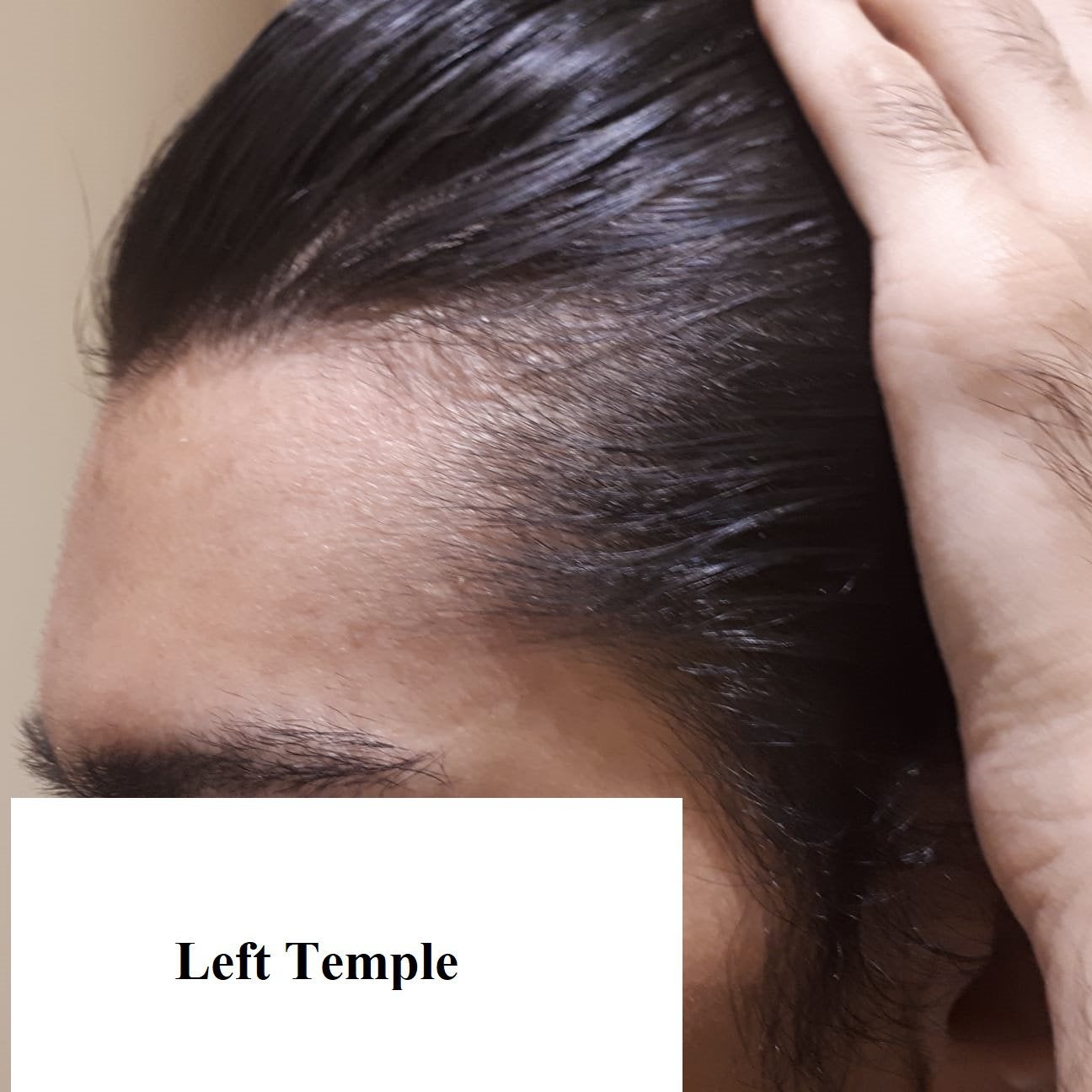 Are my temples thinning? : HaircareScience