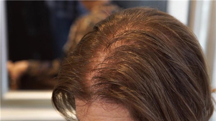 As they age, women lose their hair, too ...