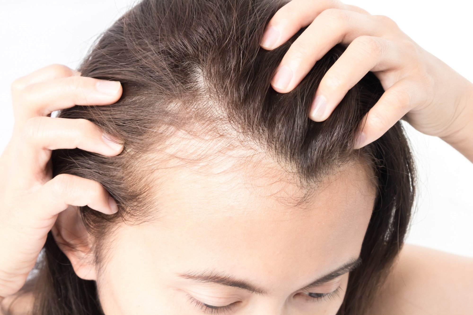 B12 Deficiency and Hair Loss: How Are They Related?