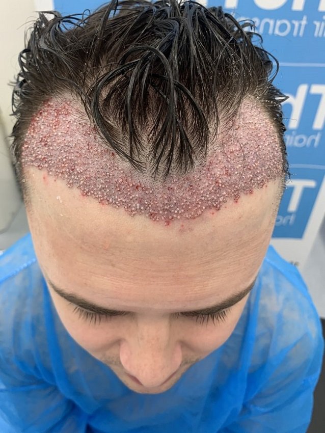 Bad hair transplant experience at the CLINIC CENTER ISTANBUL