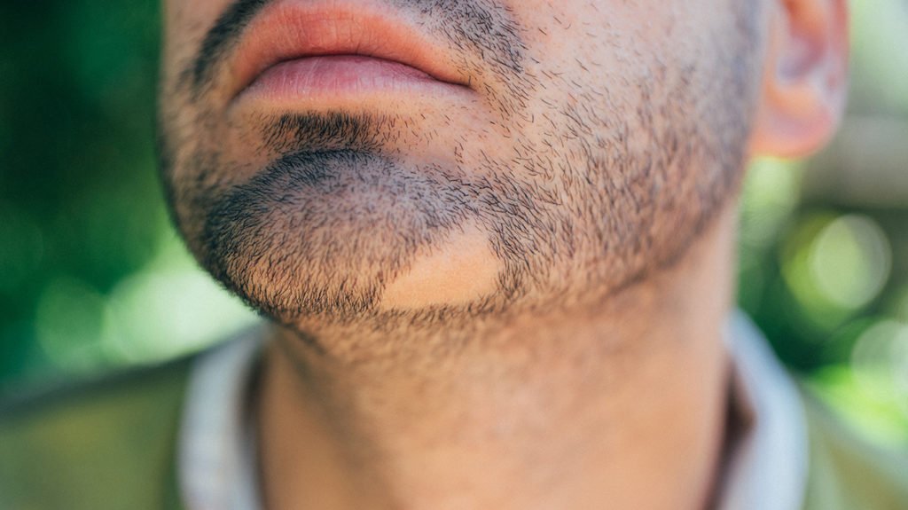 Bald patch in beard: Causes and treatments