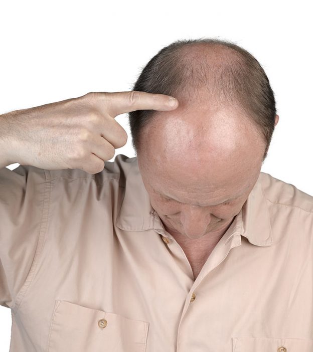 Balding In The Front Of Head