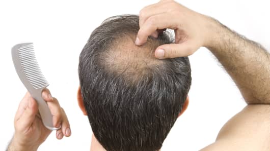 Baldness cure could be found in an osteoporosis drug ...