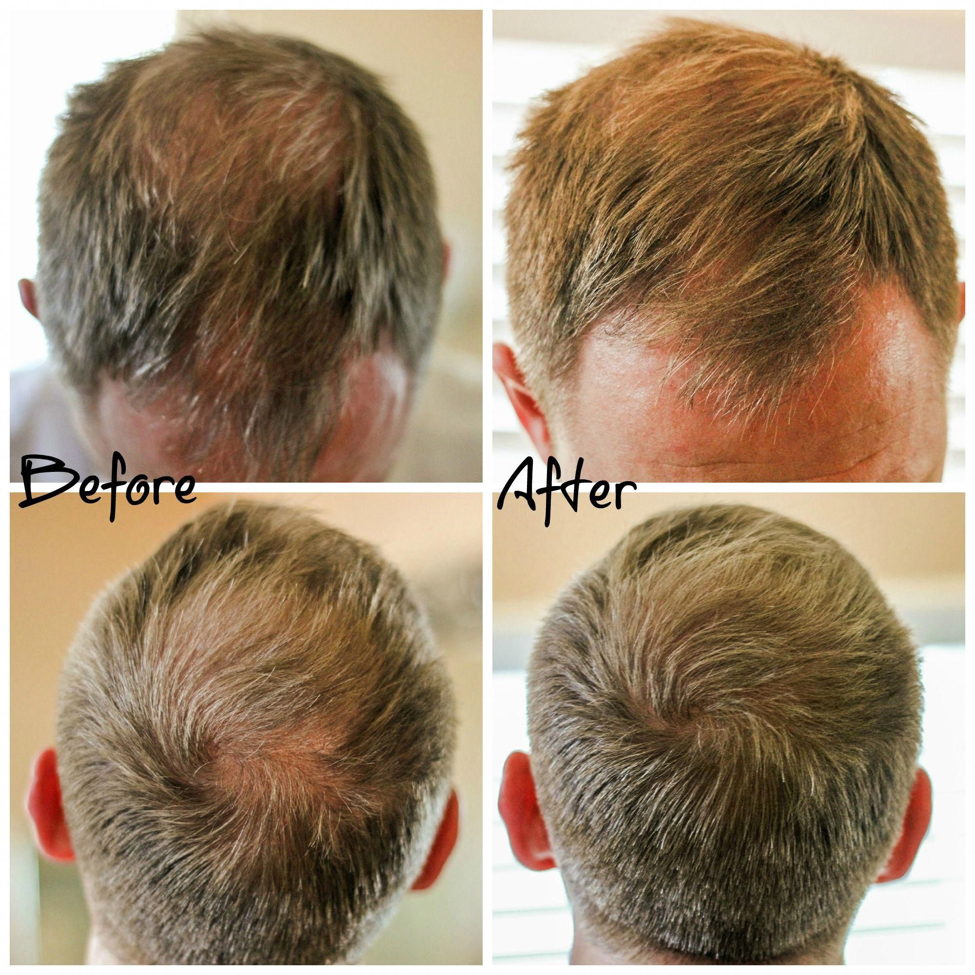 Before and After photos of using Viviscal Hair Filler ...