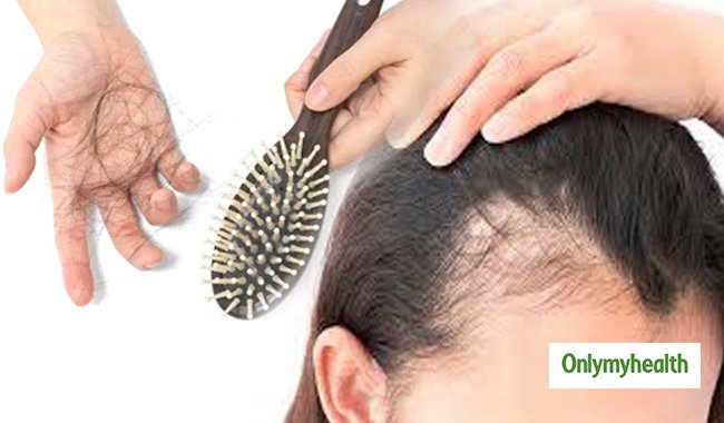 Best Home Remedies to Prevent Hair Loss in Women