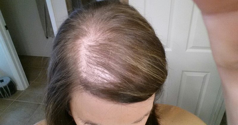 Best Treatments for Postpartum Hair Loss