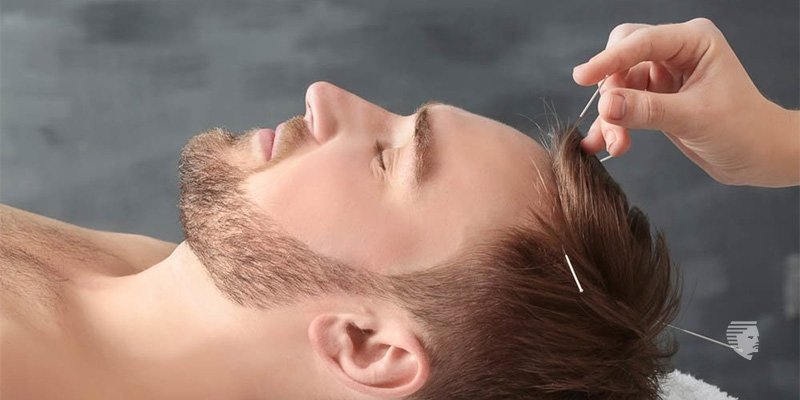 Can Acupuncture Really Affect Hair Growth?