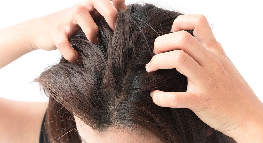 Can Dandruff Cause Hair Loss?