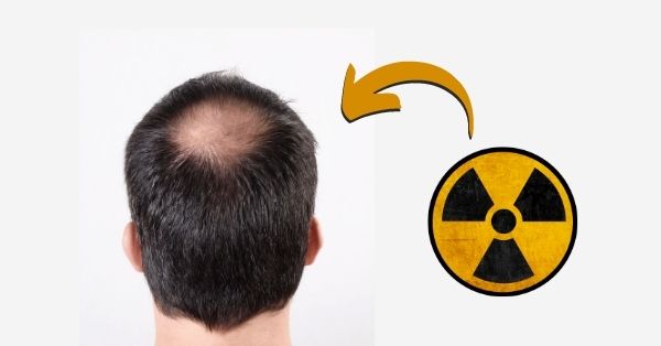 Can EMF Radiation Cause Hair Loss?