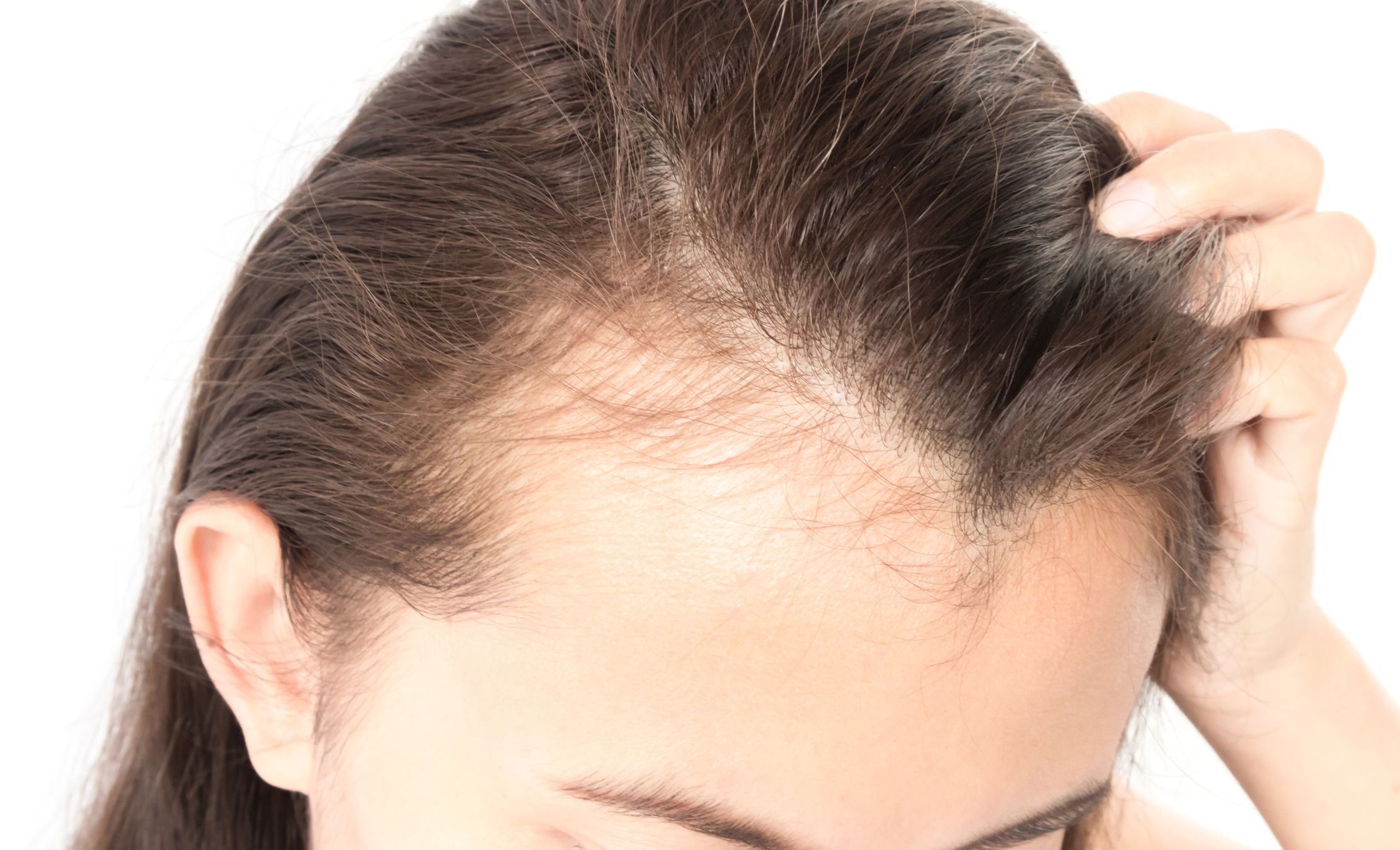 Can Food Allergies Cause Hair Loss?