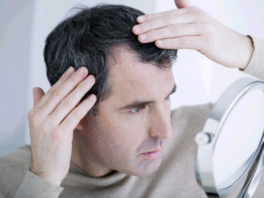 Can Hair Loss From Stress Be Reversed
