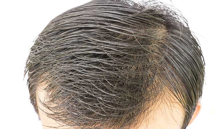 Can homeopathy help your hair grow back after thinning ...