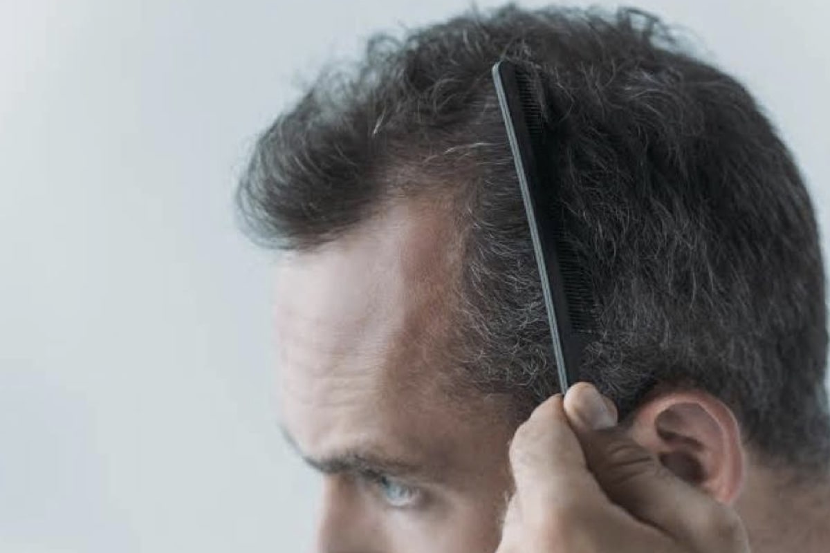 Can Liver Disease Cause Hair Loss : 7 Surprising Causes of Hair Loss ...
