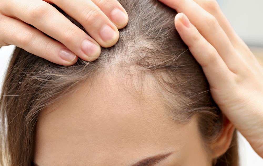 Can Microneedling Cause Temporary Hair Shedding
