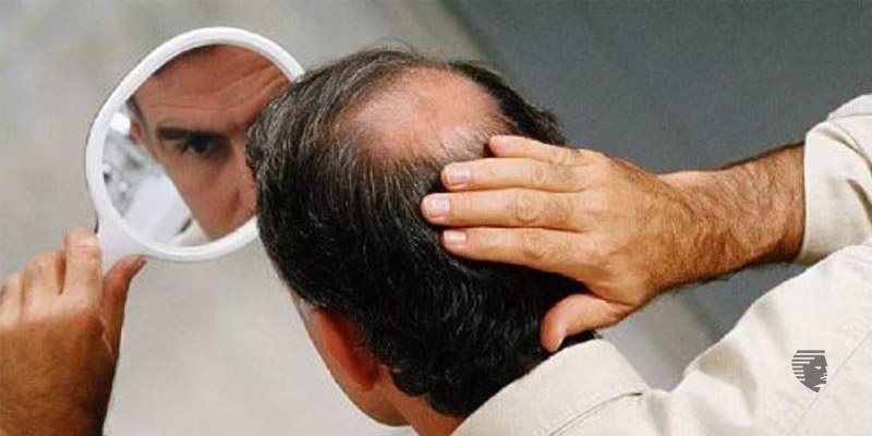 Can Obesity Cause Hair Loss?
