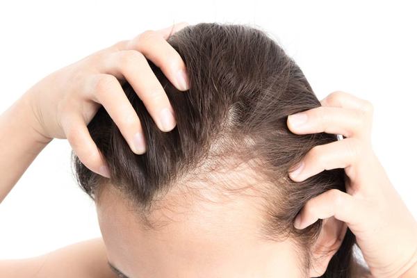 Can Polycystic Ovarian Syndrome (PCOS) Cause Hair Loss ...