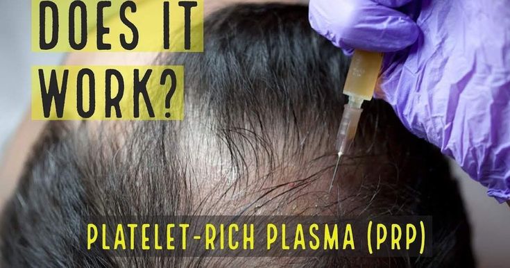 Can PRP treat hair loss? https://www.medicalnewstoday.com ...