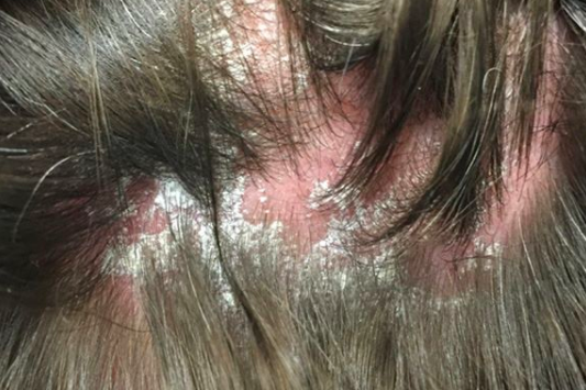 Can psoriasis also cause scarring?  Donovan Hair Clinic