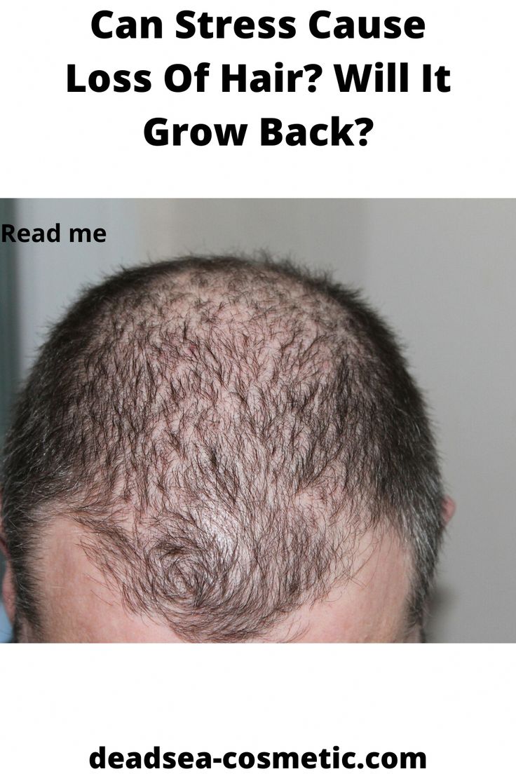 Can Stress Cause Loss Of Hair? Will It Grow Back? in 2020 ...