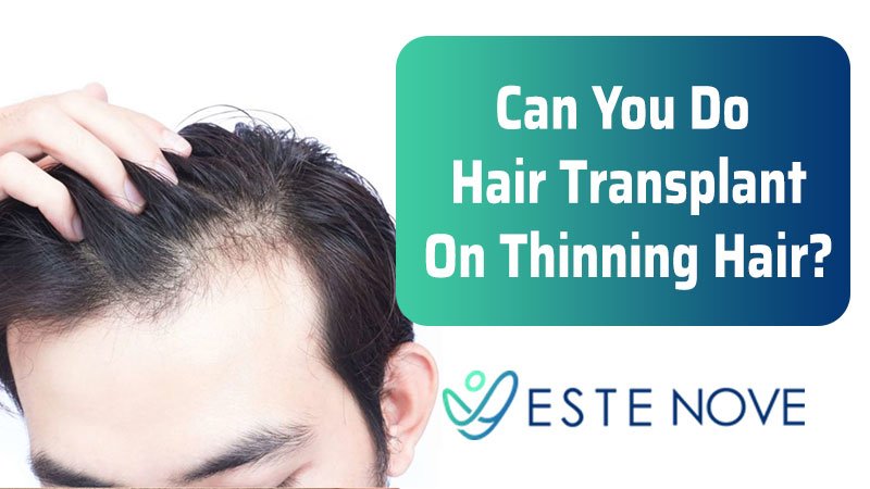 Can You Do Hair Transplant On Thinning Hair?